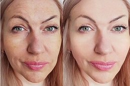 which-laser-treatment-is -for glowing-skin in dubai