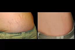 which-treatment-is-best-for-removing-stretch-marks Clinic in Dubai