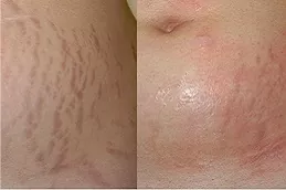 which-treatment-is-best-for-removing-stretch-marks in Abu Dhabi
