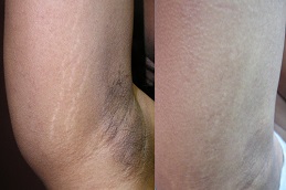 which-treatment-is-best-for-removing-stretch-marks in dubai