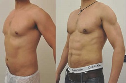 Best Clinic of Six Pack Abs in Dubai