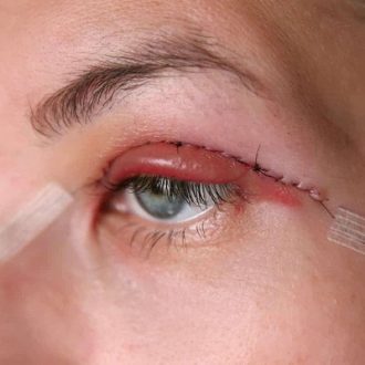 Best Eyelid Surgeon in Dubai & Abu Dhabi