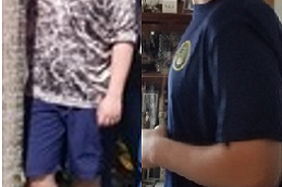 Best bariatric-surgery-for-childhood-obesity in Abu Dhabi