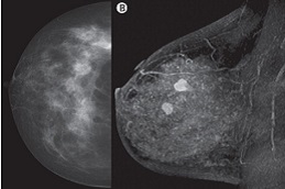 Breast Cancer treatment Cost Dubai