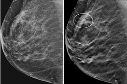 Breast Cancer Screening in Dubai