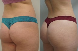 Best buttock-doctor Clinic in Dubai