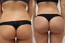 Best buttock-doctor in Abu Dhabi