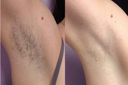 Best can-you-go-swimming-after-getting-laser-hair-removal Clinic in Dubai