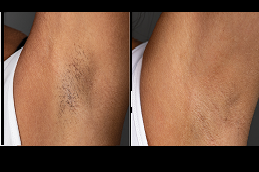 Best can-you-go-swimming-after-getting-laser-hair-removal in Abu Dhabi