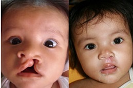 Best cleft-lip-and-palate-surgery-cost Clinic in Dubai
