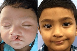 Best cleft-lip-and-palate-surgery-cost in Abu Dhabi
