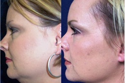 Best double-chin-removal-cost Clinic in Dubai