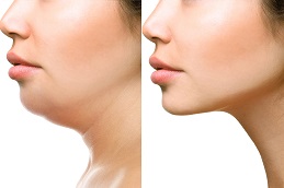 Best double-chin-removal-cost in Abu Dhabi