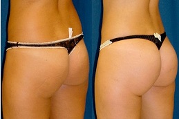 Best french-butt-reshaping-cost Clinic in Dubai