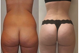 Best french-butt-reshaping-cost in Abu Dhabi