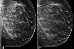 Best how-much-does-a-mammogram-cost