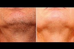 Best is-laser-hair-removal-cancerous Clinic in Dubai