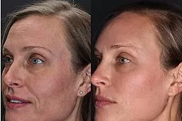 Best jawline-fillers-cost Dubai