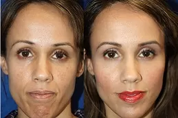  Best jawline fillers cost in Dubai