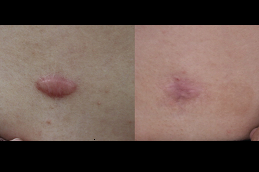 Best keloid-removal-treatment-pros-and-cons Clinic in Dubai