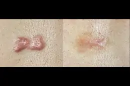 Best keloid-removal-treatment-pros-and-cons in Abu Dhabi