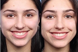 Best lip-enlargement-cost Clinic in Dubai