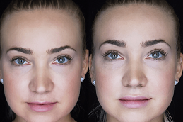 Best lip-enlargement-cost in Abu Dhabi