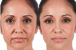 Best liquid-facelift-cost Clinic in Dubai