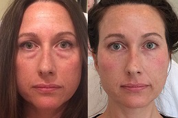 Best liquid-facelift-cost in Abu Dhabi