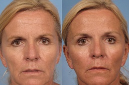 Best makeover-cosmetic-surgery-cost Clinic in Dubai
