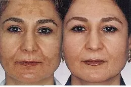 Best pigmentation-laser-treatment-cost Clinic in Dubai