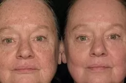 Best pigmentation-laser-treatment-cost in Abu Dhabi