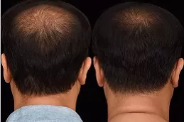 Best regenera-activa-treatment-cost Clinic in Dubai