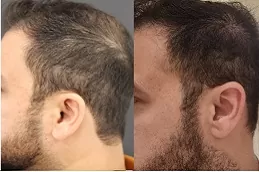 Best regenera-activa-treatment-cost in Abu Dhabi