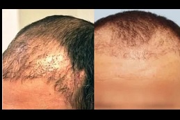 Best sideburn-hair-transplant Clinic in Dubai