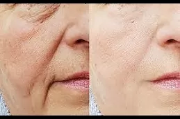 Best sunekos-injections-cost Clinic in Dubai