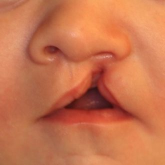 Cleft Lip and Palate Surgery Cost in Dubai