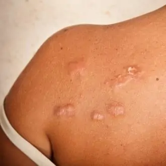 Keloid Removal Treatment Pros and Cons