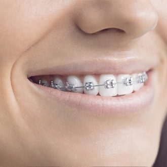 Cheap Metal Braces Cost in Dubai & Abu Dhabi