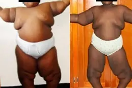 bariatric-surgery-for-childhood-obesity in dubai