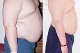 best bariatric-surgery-for-childhood-obesity in dubai