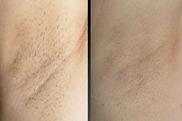 best can-you-go-swimming-after-getting-laser-hair-removal in dubai