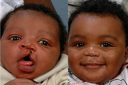 best cleft-lip-and-palate-surgery-cost in dubai