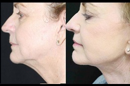 best double-chin-removal-cost in dubai