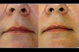  best is-laser-hair-removal-cancerous in dubai