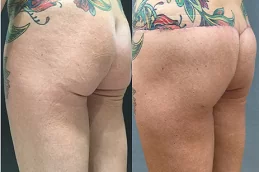 best french-butt-reshaping-cost in dubai