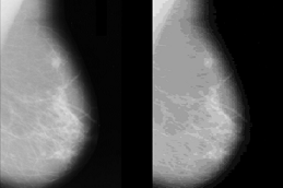 best how-much-does-a-mammogram-cost in dubai