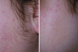 best-is-laser-hair-removal-cancerous-in-dubai.