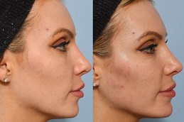 best jawline-fillers-cost in dubai