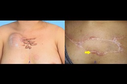 best keloid-removal-treatment-pros-and-cons in dubai